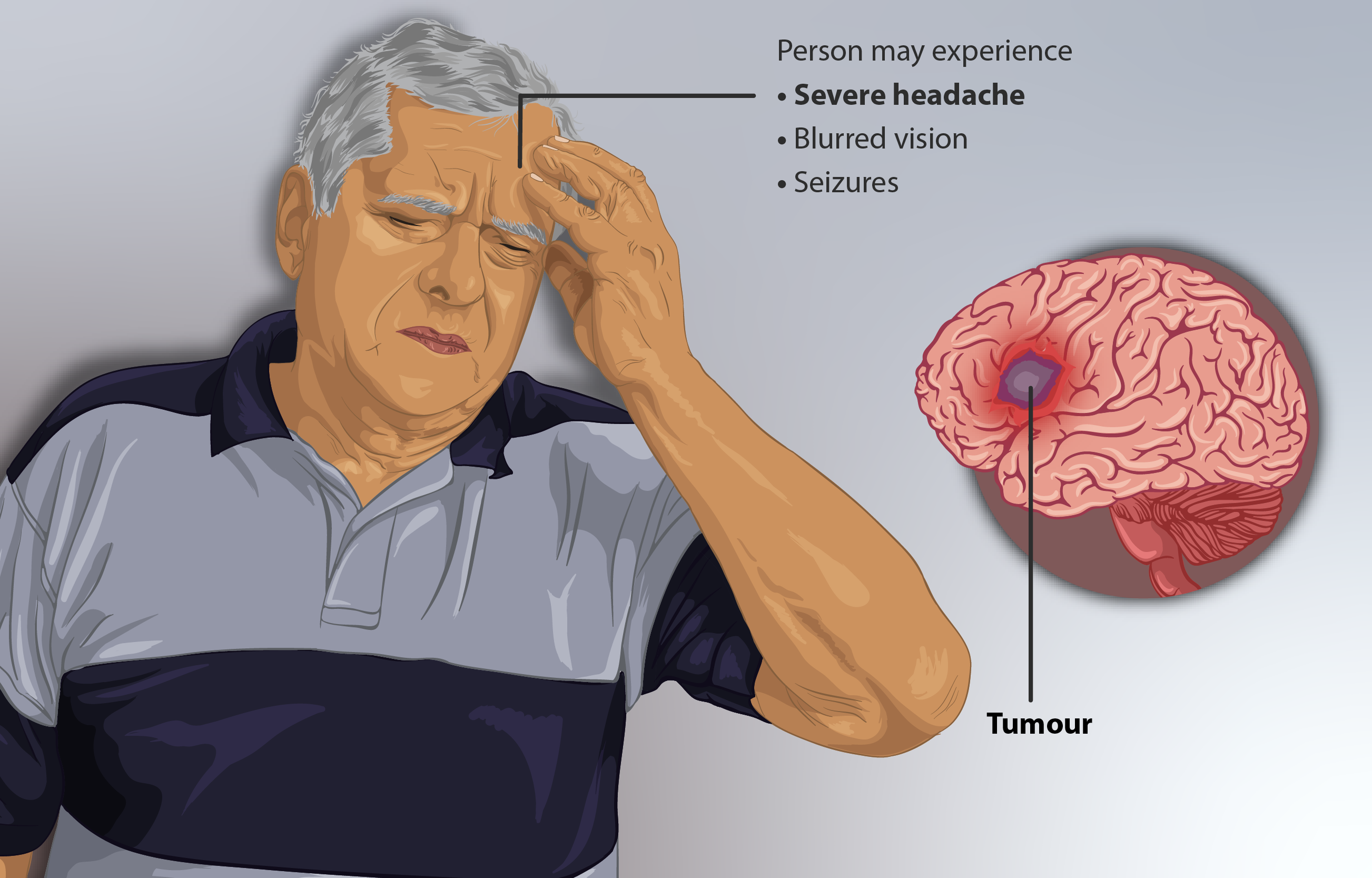 World Brain Tumor Day 2023 June 8: ਬ੍ਰੇਨ ਟਿਊਮਰ ਦੇ ਸ਼ੁਰੂਆਤੀ ਸੰਕੇਤ ਹੈ ਸਿਰਦਰਦ, ਜਾਣੋ ਲੱਛਣ ਅਤੇ ਇਲਾਜ