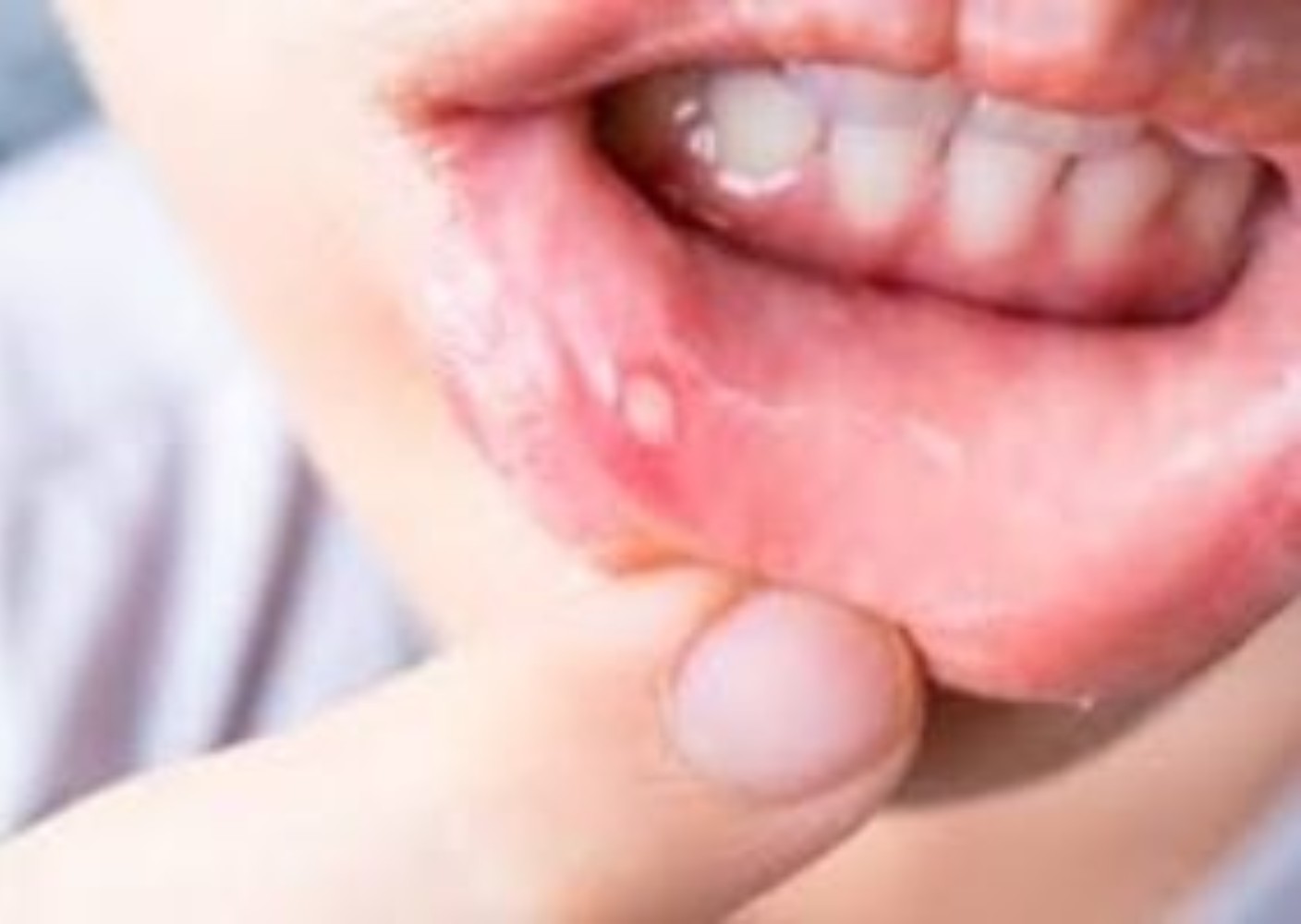 Mouth Tips: ਮੂੰਹ ਦੇ ਛਾਲਿਆਂ ਦਾ ਘਰੇਲੂ ਇਲਾਜ ਕੀ ਹੈ?